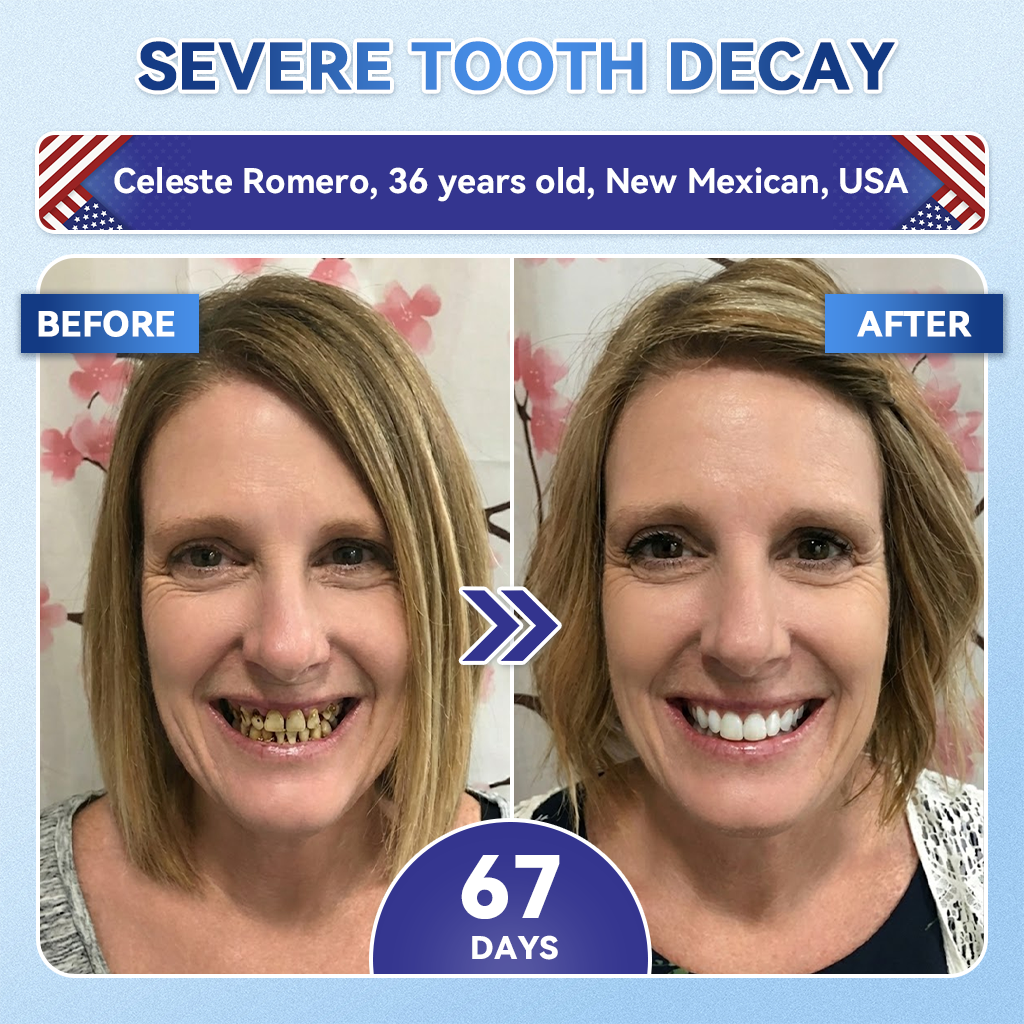 Your Smile~ Smileasego® 𝑇𝑖𝑑𝑒𝑔𝑙𝑢𝑠𝑖𝑏 𝑇𝑜𝑜𝑡ℎ & 𝐺𝑢𝑚 𝑅𝑒𝑝𝑎𝑖𝑟 𝐹𝑎𝑠𝑡-𝐷𝑖𝑠𝑠𝑜𝑙𝑣𝑖𝑛𝑔 𝑊ℎ𝑖𝑡𝑒𝑛𝑖𝑛𝑔 𝑆𝑡𝑟𝑖𝑝𝑠  (𝟓-𝐢𝐧-𝟏 💎 𝐑𝐞𝐛𝐮𝐢𝐥𝐝 𝐄𝐧𝐚𝐦𝐞𝐥 & 𝐃𝐞𝐧𝐭𝐢𝐧 • 𝐒𝐭𝐫𝐞𝐧𝐠𝐭𝐡𝐞𝐧 𝐆𝐮𝐦𝐬 • 𝐄𝐫𝐚𝐝𝐢𝐜𝐚𝐭𝐞 𝐓𝐚𝐫𝐭𝐚𝐫 & 𝐎𝐝𝐨𝐫 • 𝐖𝐡𝐢𝐭𝐞𝐧𝐢𝐧𝐠 • 𝐒𝐭𝐨𝐩 𝐓𝐨𝐨𝐭𝐡 𝐒𝐞𝐧𝐬𝐢𝐭𝐢𝐯𝐢𝐭𝐲)